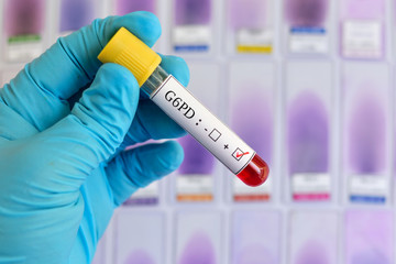 Blood sample positive with G6PD (Glucose-6-phosphate dehydrogenase) deficiency test
