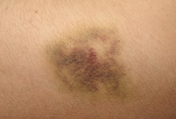 Nasty looking bruise, real
