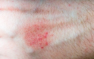Allergic rush or aczema on skin.