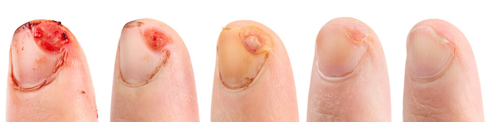 Healing of cut finger, five images isolate on white