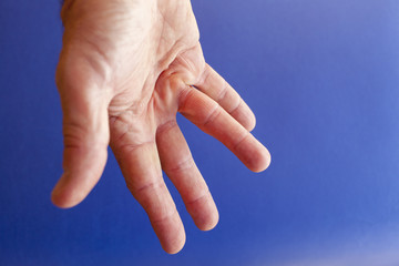 Hand of an man with Dupuytren contracture  disease, against  medical blue background, isolated 