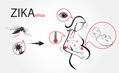 Zika virus fever infographic vector.