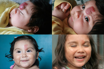 Infantile hemangioma that had treatment with propranolol