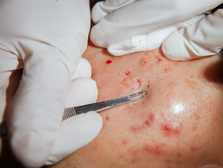 close up acne removal treatment at beauty salon