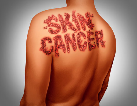 Skin Cancer Melanoma
