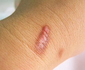 Scar on human  skin