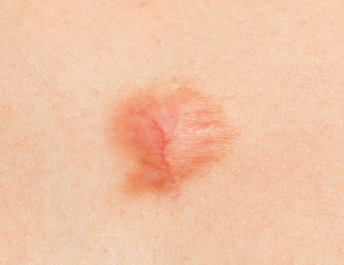 round scar on the skin burn