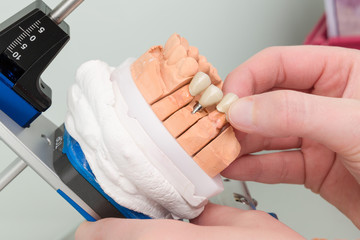 Im Dentallabor wird ein Zahnimplantat im Artikulator geprüft