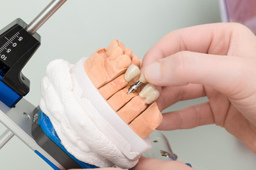 Im Dentallabor wird ein Zahnimplantat im Artikulator geprüft