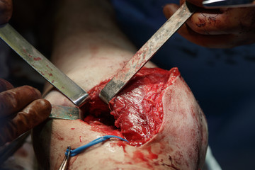 Knee Surgery.
wound on the leg with muscles expanded by surgical tools during the operation.