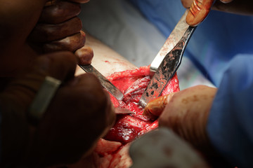 Bloodstained Surgical Tool.
using different surgical tools during the operation close-up.
