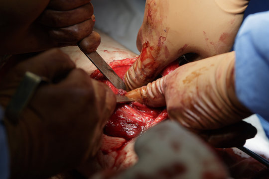 Fingers in Wound.
Surgeon puts his fingers inside the wound during the operation.