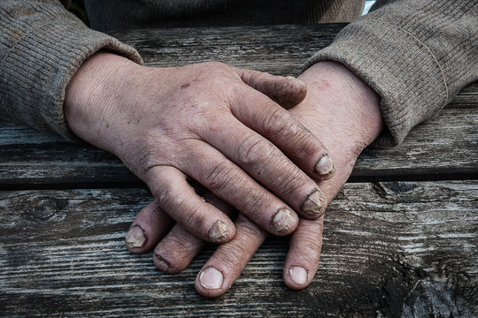 Fungal Nail Infection