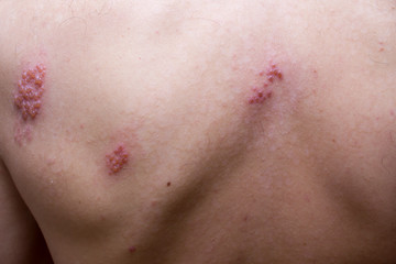 Shingles on men herpes zoster. Closeup.