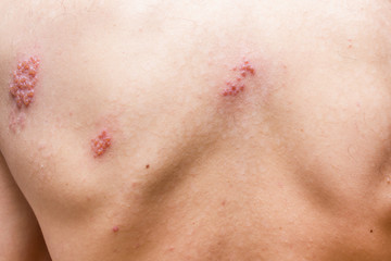 Shingles on men herpes zoster. Closeup.