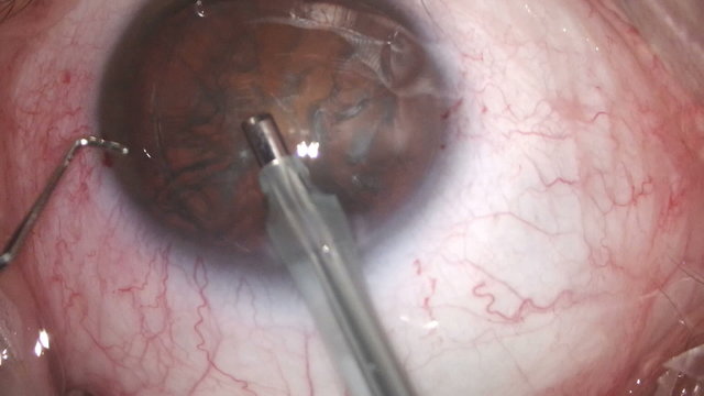Close-up view of cataract removal surgery from human eyeball