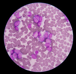 Myeloblasts showing in blood smear.