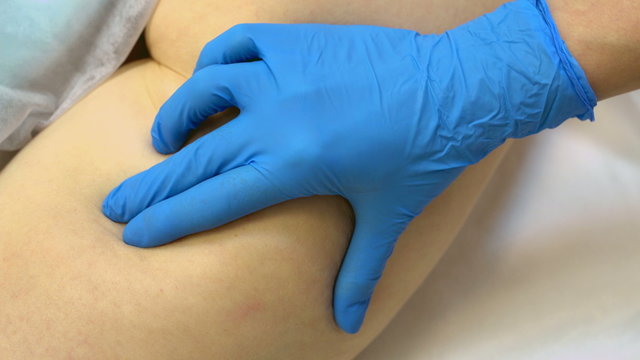 Cellulitis. Doctor's hands massaged hip women