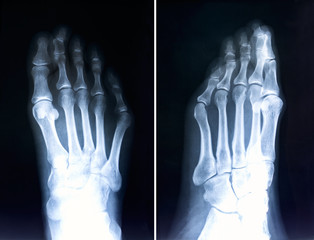 X-ray of foot fingers.Radiography with deformed toes.Hallux valg