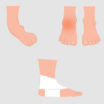 Dislocation of the foot. Vector illustration