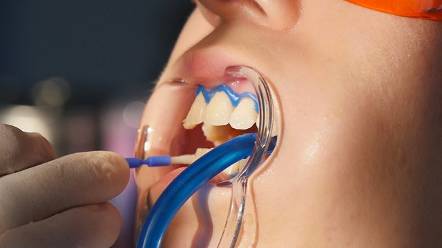Whitening teeth closeup in slow motion