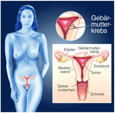 Geb&auml;rmutterkrebs.Tumor