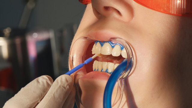 Whitening teeth closeup in slow motion