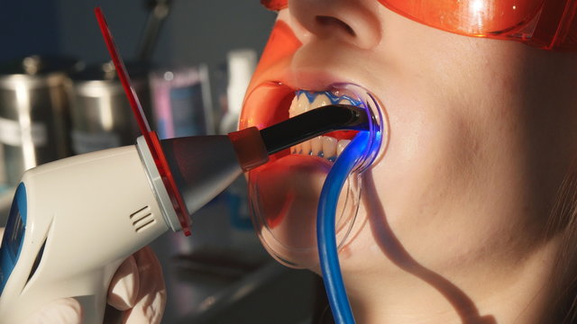 Dentist working with dental polymerization lamp in oral cavity.