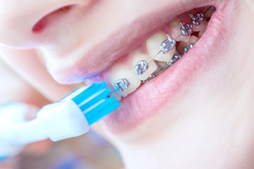 Beautiful smiling girl with retainer for teeth brushing teeth .