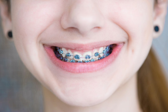 Teeth with braces.