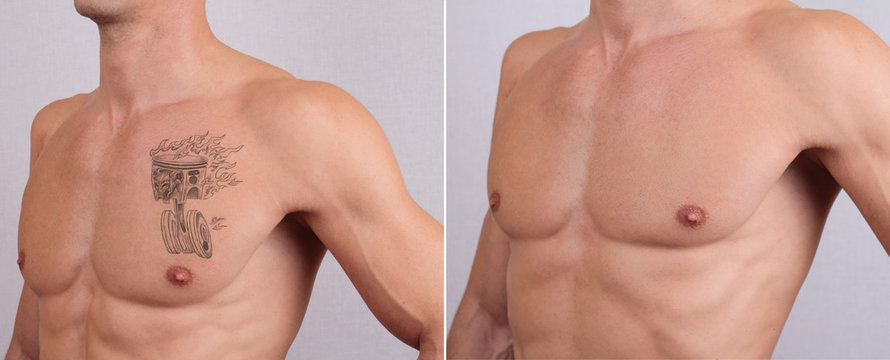 Before  After Photos of Sydney Laser Tattoo Removal Treatments