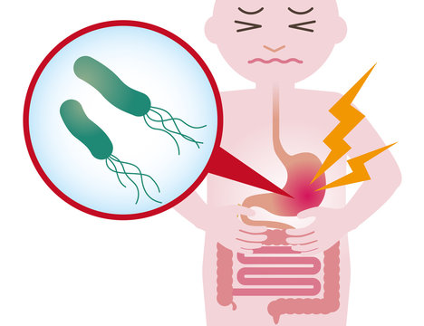 human stomach and Helicobacter pylori, stomach ache, gastric ulcer, simplified illustration
