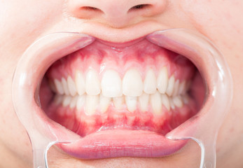 Close-up of frontal view of woman white teeth