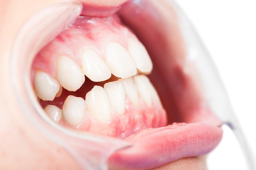 Close-up of side view of female patient cavity and teeth