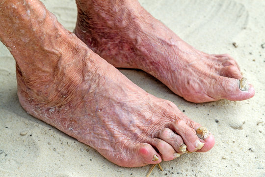 Diseased legs of an old woman