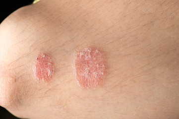 skin disease psoriasis closeup