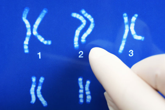 Arzt oder Forscher für Gentechnik oder Genetik wertet Karyogramm mit Chromosomen aus 