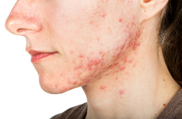  Young girl with skin problem