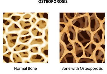 Illustration of normal bone and bone with osteoporosis