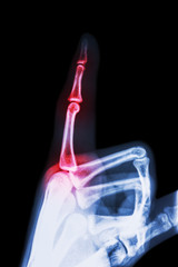 Rheumatoid arthritis , Gouty arthritis ( film x-ray index finger and hand ( point a finger ) and...
