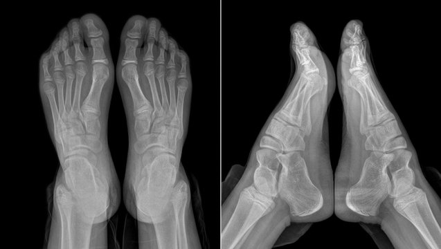 X-ray image of the girl's feet (with partially outlined trousers)