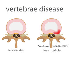 back pain. herniated disc. vertebrae disease vector format