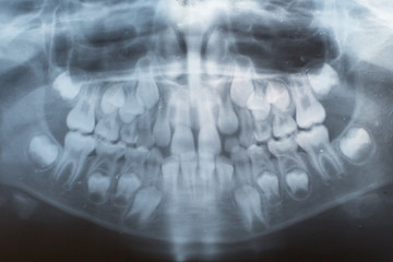 X-rays of teeth