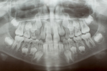 X-rays of teeth