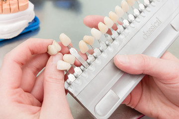 Zahnfarbe eines Implantats wird im Dentallabor geprüft