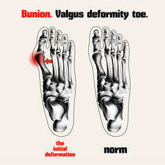 Bunion. Valgus deformity toe.