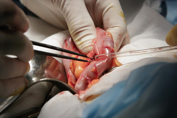 Cauterizing the Colon / surgeon uses coagulator cauterizing vessels in colon during making of...