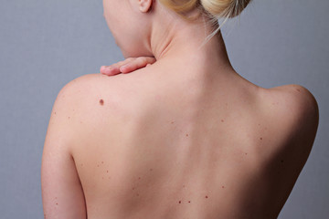 Checking benign moles : Woman with  birthmarks on her back . Sun Exposure effect on skin, Health Effects of UV Radiation