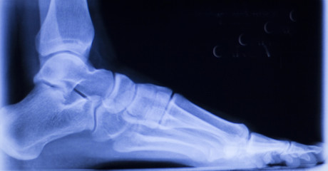 Foot and toes injury xray scan