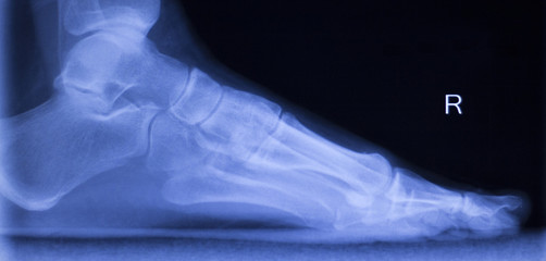 Foot heel ankle injury xray scan